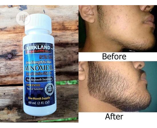 MInóxidil Kirkland