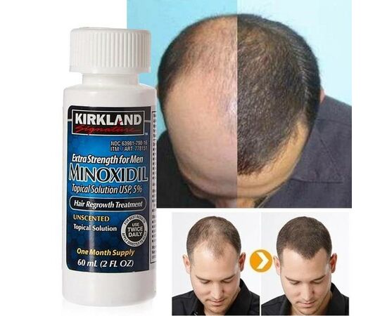 MInóxidil Kirkland